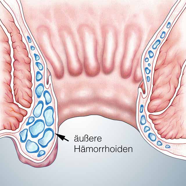 H�morrhoiden au�en