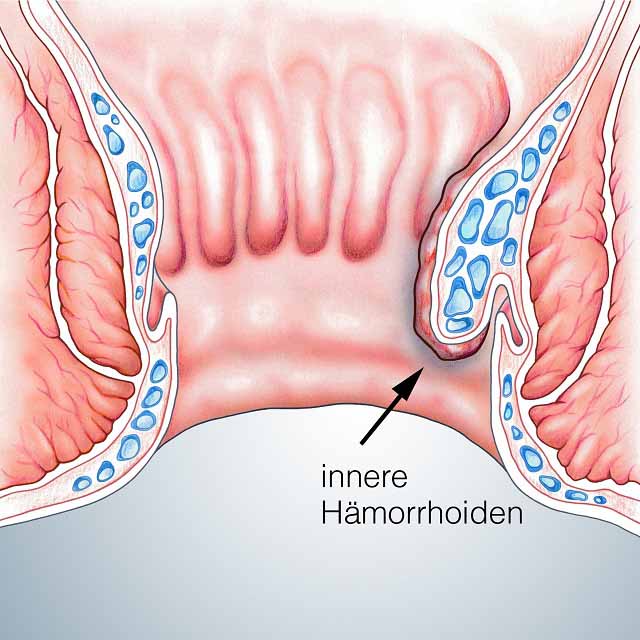 H�morrhoiden innen